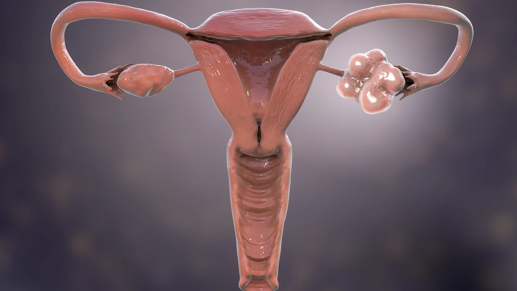 Foto: Hormonale aandoening die miljoenen vrouwen treft krijgt nieuwe naam