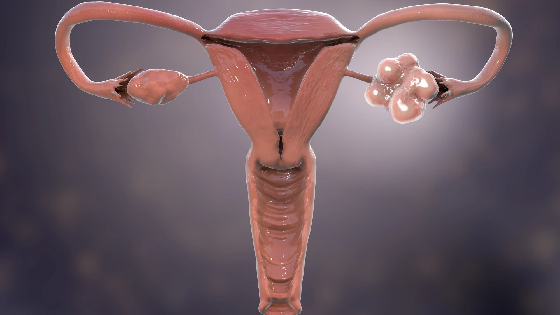 Hormonale aandoening die miljoenen vrouwen treft krijgt nieuwe naam