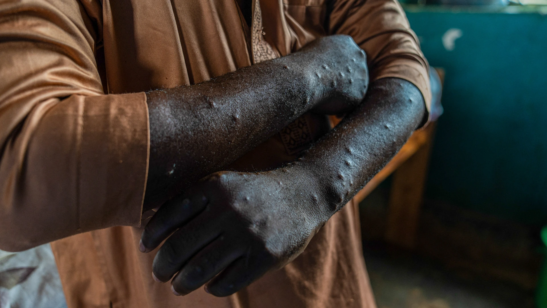 Nederlandse viroloog aangeklaagd in VS voor smokkel flesjes met mpox